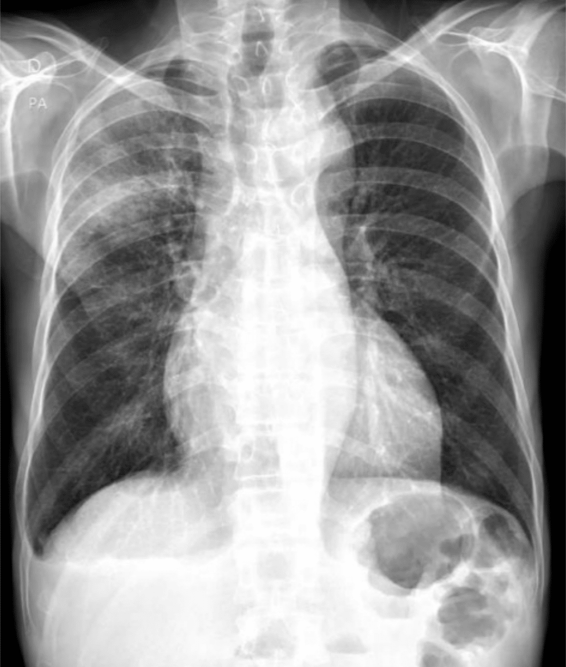 Pneumonia: Causas, Sintomas e Importância da Prevenção