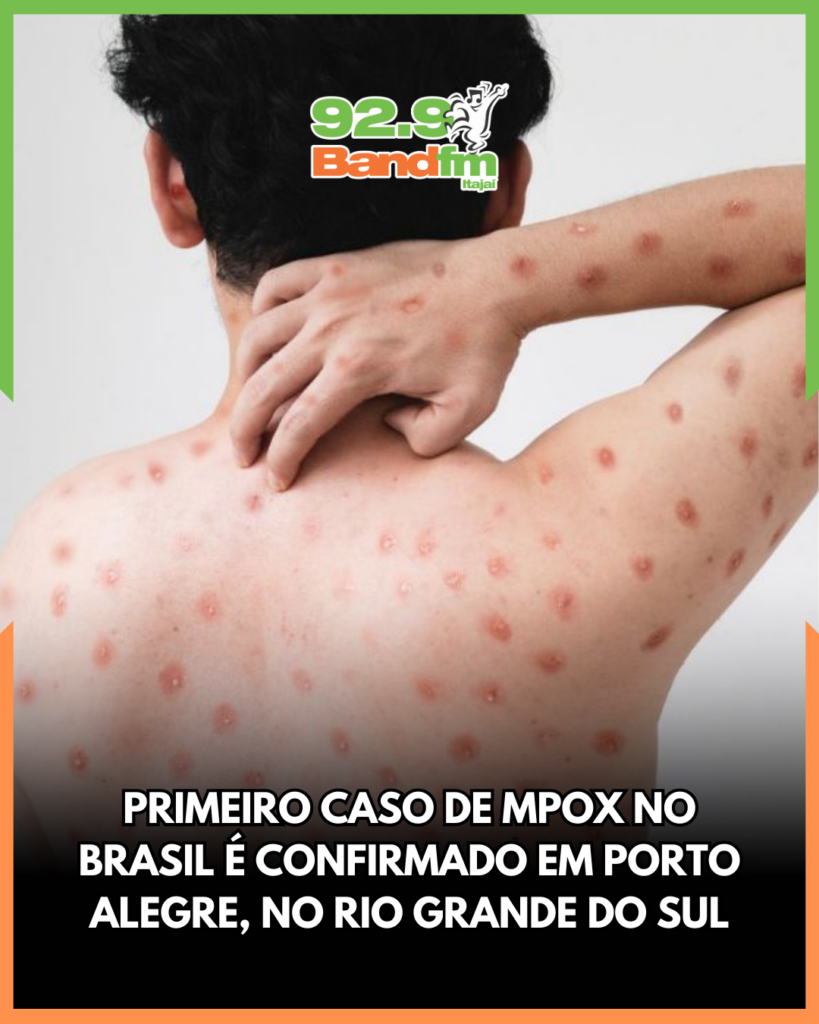 Mpox no Brasil: situação atual, sintomas e prevenção
