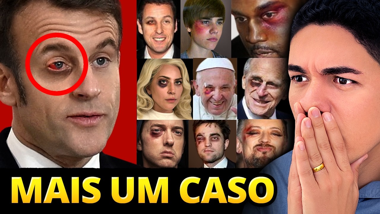 Olho roxo em famosos: causas, cobertura midiática e cuidados