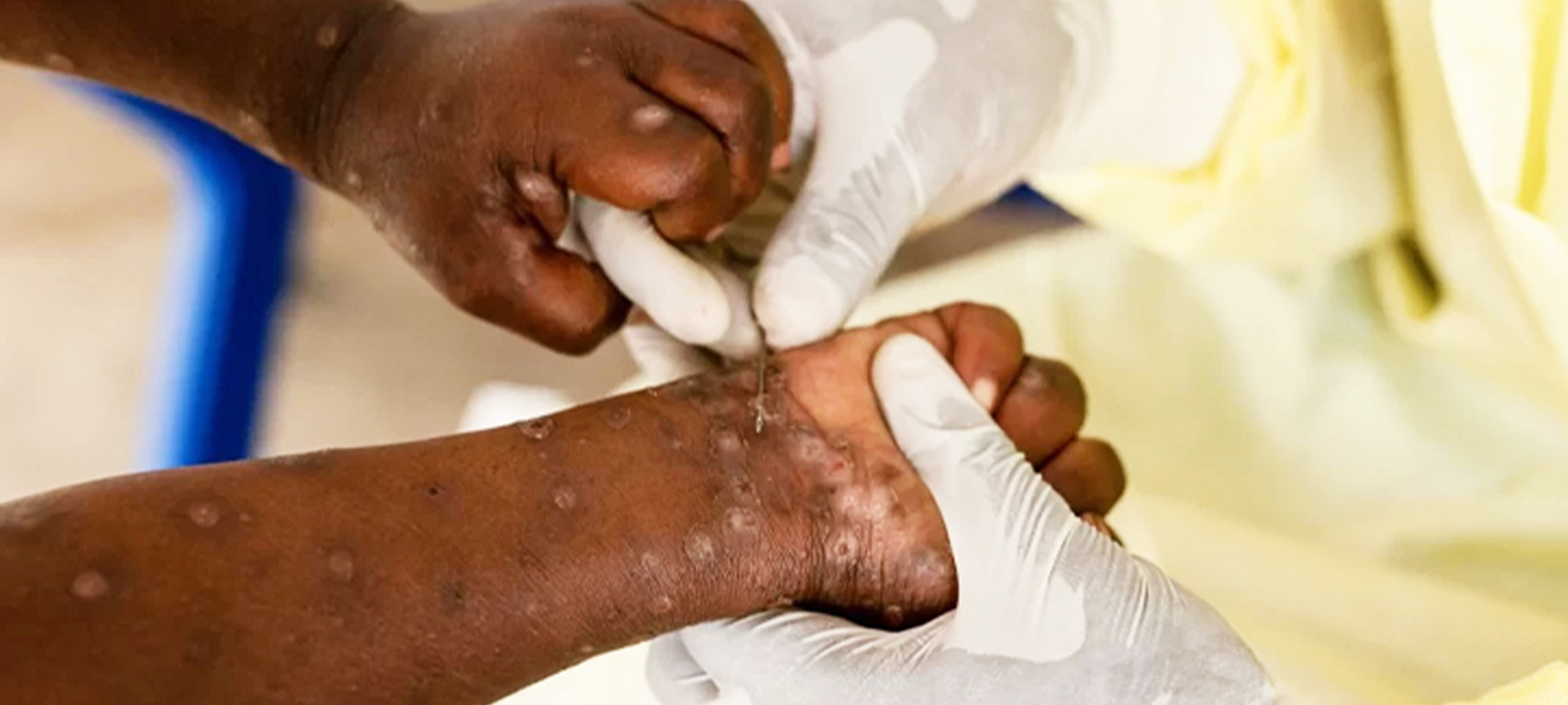 Mpox casos: o que saber sobre sintomas, transmissão e prevenção