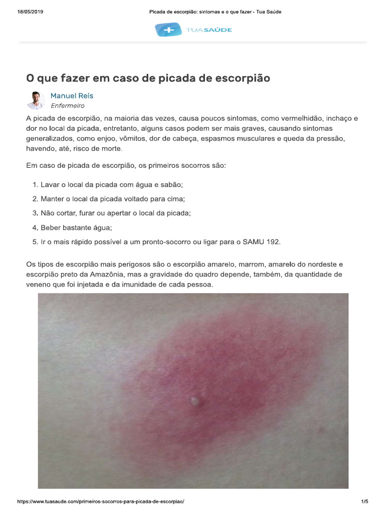 Picada de escorpião: o que fazer, sintomas e prevenção